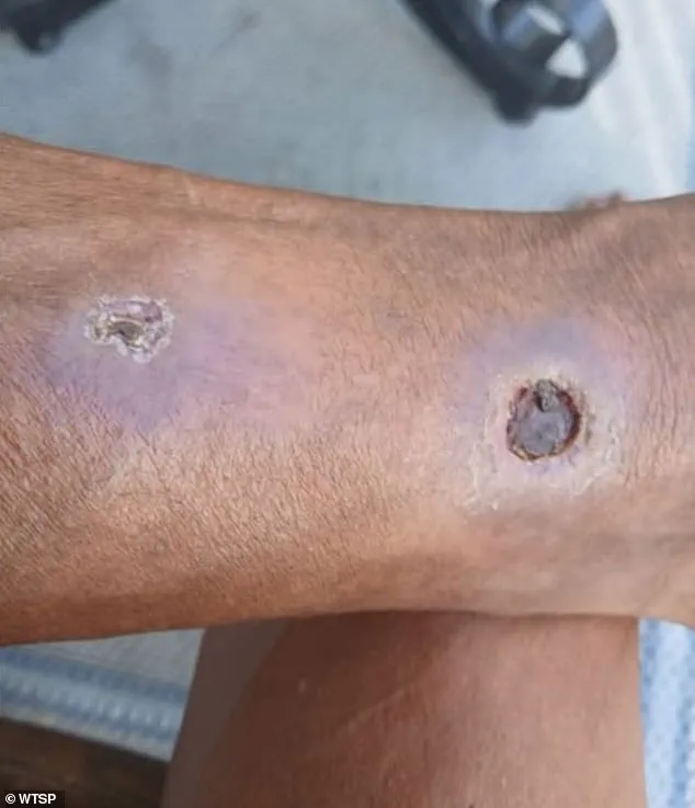 Florida Woman Sues Apartment Complex for Negligence After Spider Infestation Led to Toe Amputation