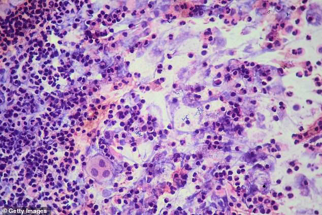 Public Health Emergency: California School Lockdown as TB Outbreak Confirmed by SFDPH