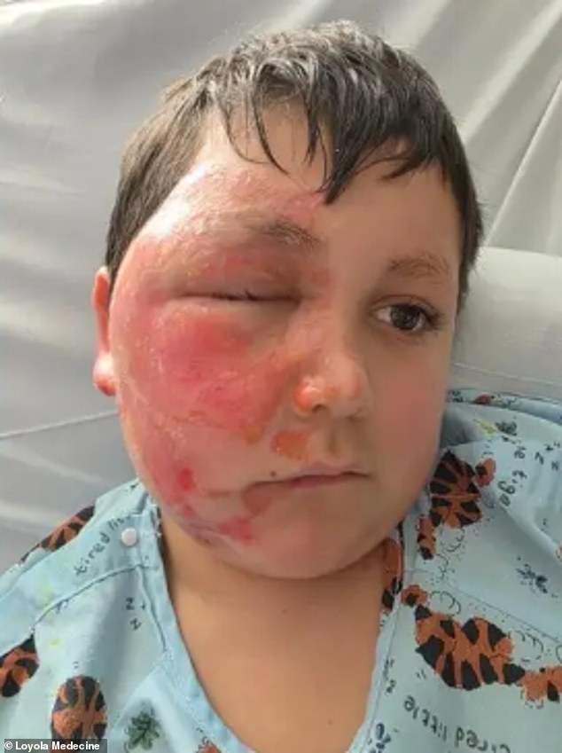 14-Year-Old Girl Hospitalized with Life-Threatening Burns After Attempting Viral TikTok 'Fire Breathing' Challenge in Pennsylvania