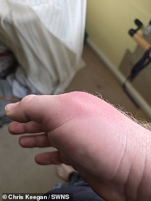 Coventry Man's Spider Bite Infection Sparks Concerns Over False Widow Spread in UK