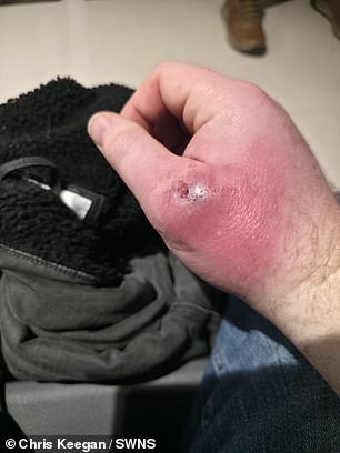 Coventry Man's Spider Bite Infection Sparks Concerns Over False Widow Spread in UK