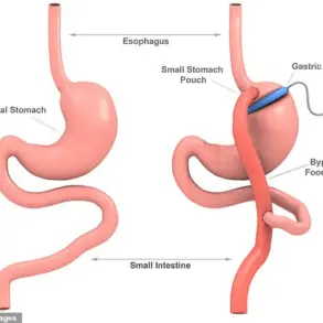 My Gastric Bypass: A Tale of Two Stomachs