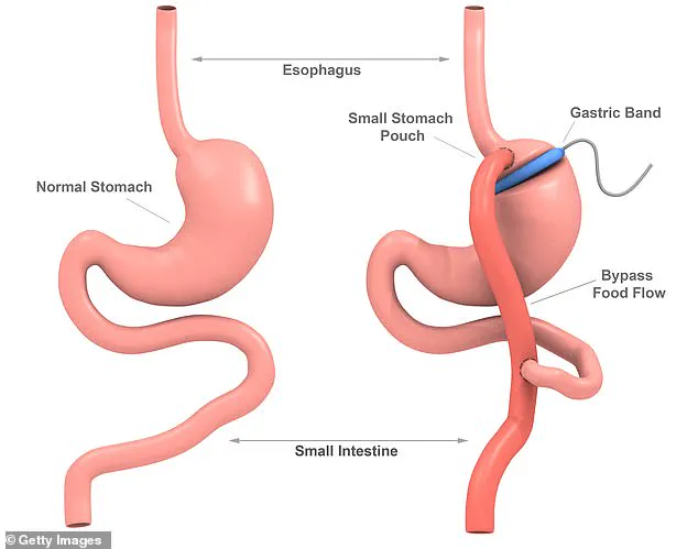 My Gastric Bypass: A Tale of Two Stomachs