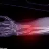 GLP-1 Agonists Linked to Osteoporosis Risk, Warns Royal Osteoporosis Society