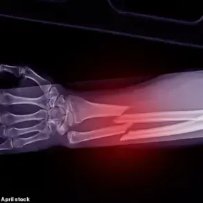 GLP-1 Agonists Linked to Osteoporosis Risk, Warns Royal Osteoporosis Society
