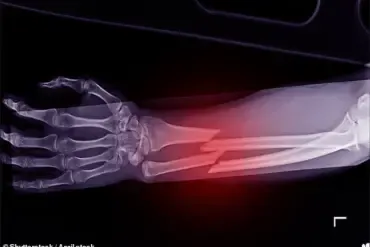 GLP-1 Agonists Linked to Osteoporosis Risk, Warns Royal Osteoporosis Society