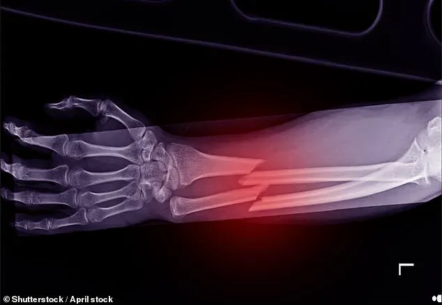 GLP-1 Agonists Linked to Osteoporosis Risk, Warns Royal Osteoporosis Society