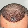 Warning Over Lack of Regulation in International Cosmetic Procedures: Surgeon Highlights Risks of Cheap Hair Transplants Abroad
