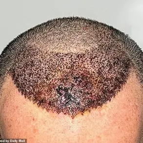 Warning Over Lack of Regulation in International Cosmetic Procedures: Surgeon Highlights Risks of Cheap Hair Transplants Abroad