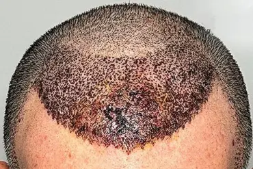 Warning Over Lack of Regulation in International Cosmetic Procedures: Surgeon Highlights Risks of Cheap Hair Transplants Abroad