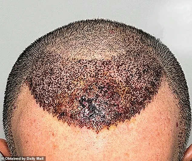 Warning Over Lack of Regulation in International Cosmetic Procedures: Surgeon Highlights Risks of Cheap Hair Transplants Abroad